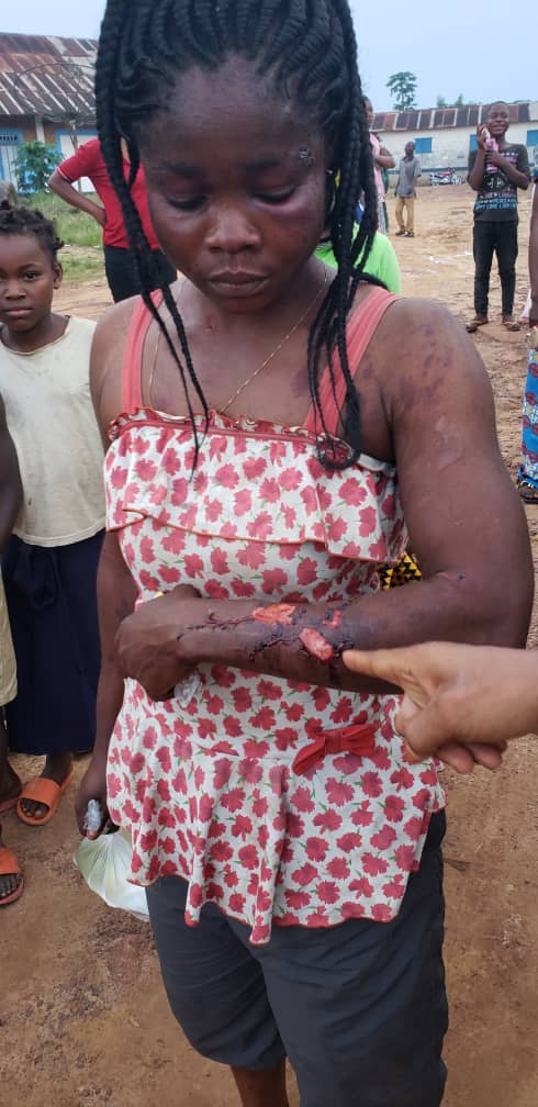 Paní Cécile Boita ukazuje zranění, která utrpěla od armády, policie a stráží PHC.